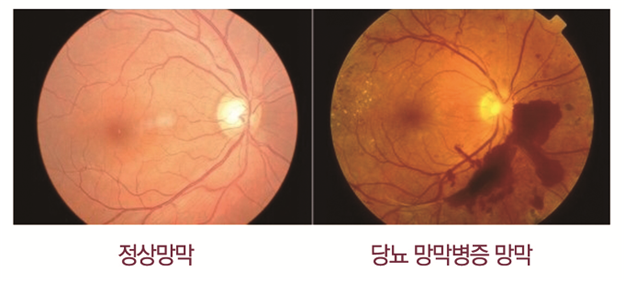 정상망막,당뇨 망막병증 망막