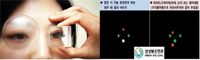 사시 사진