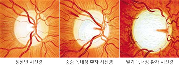 정상인 시신경, 녹내장 환자 시신경